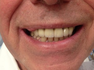 Before and after: front dental bridge restoring worn teeth (after)