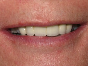 After treatment - Front bridge replacement