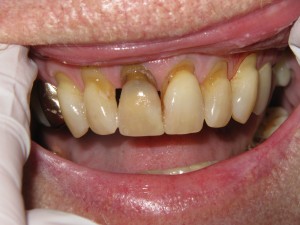 Before treatment - Six crowns - abfraction repair