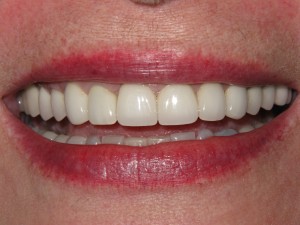 After treatment - Six crowns - enamel wear