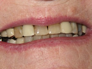 Before treatment - Six porcelain crowns
