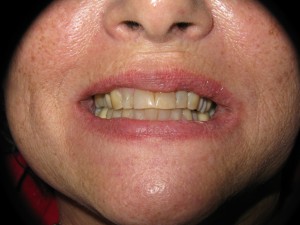 Before and after: restoration of the six front teeth (before)