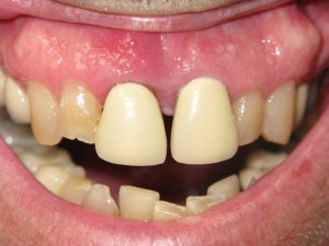 Before and after: front dental bridge restoring worn teeth (before)