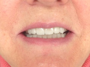 Before and after: cosmetic smile makeover (after)