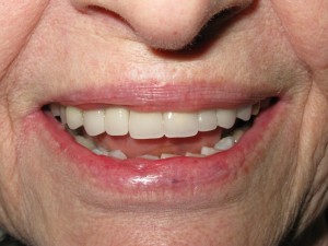 After treatment - Cosmetic restoration