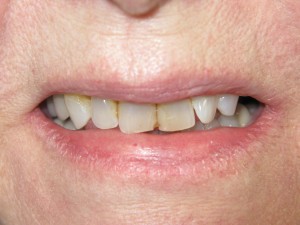 Before treatment - Porcelain veneers