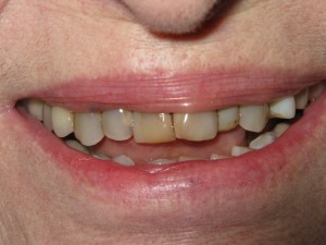 Before treatment - Cosmetic restoration