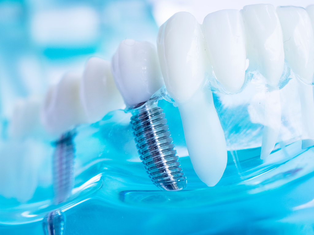 Dental Implants in Hendersonville NC