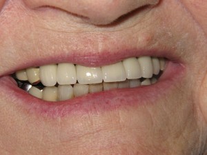 After treatment - Six porcelain crowns