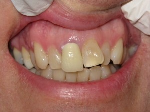 Before and after: crown restoration (before)