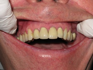 Before and after: full smile restoration (before)