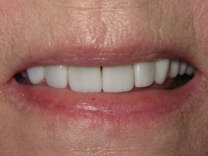 After treatment - Porcelain veneers