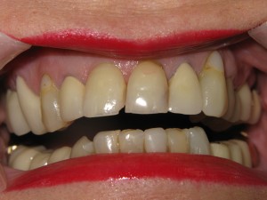 Before and after: cosmetic smile makeover (before)