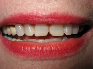Before treatment - Six crowns - enamel wear
